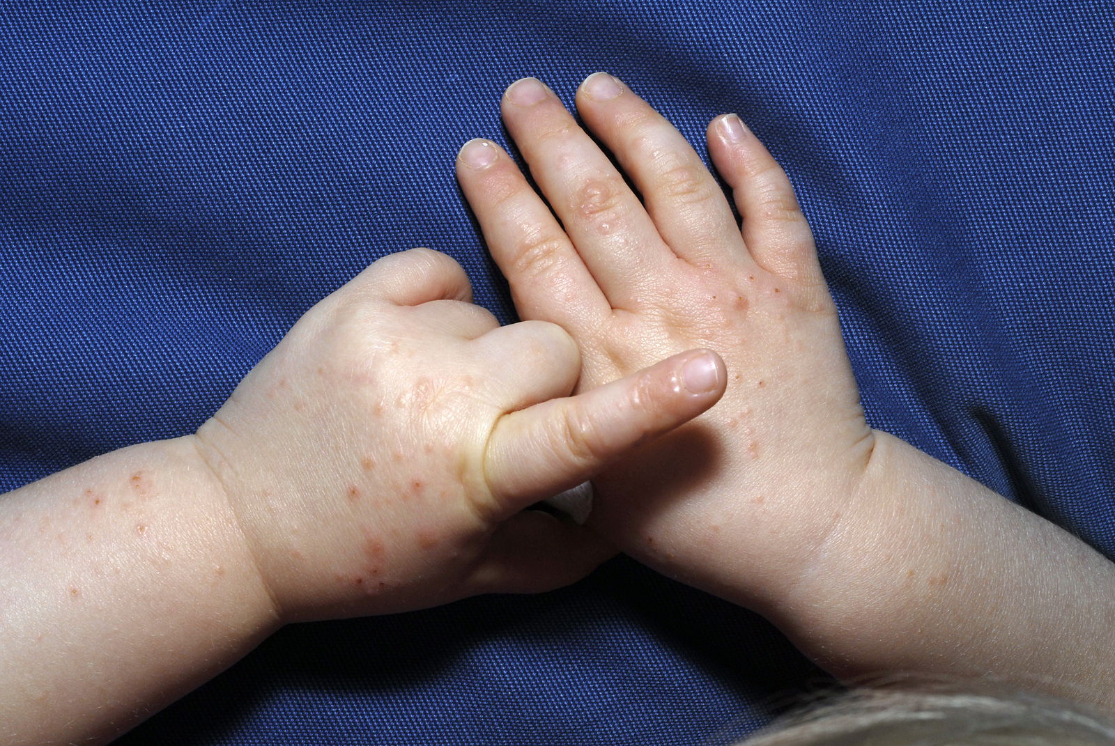 Hand-Mund-Fuß-Krankheit bei Kleinkind