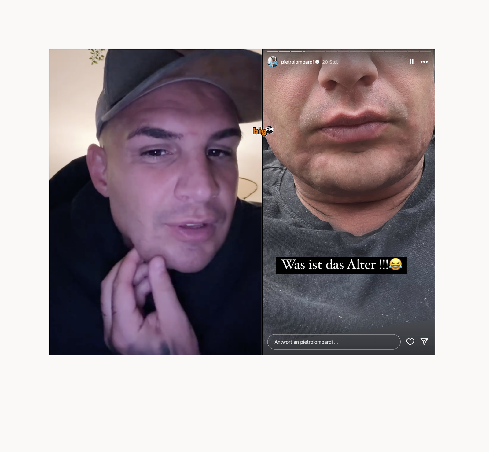 Pietro Lombardi - Gesicht allergische Reaktion