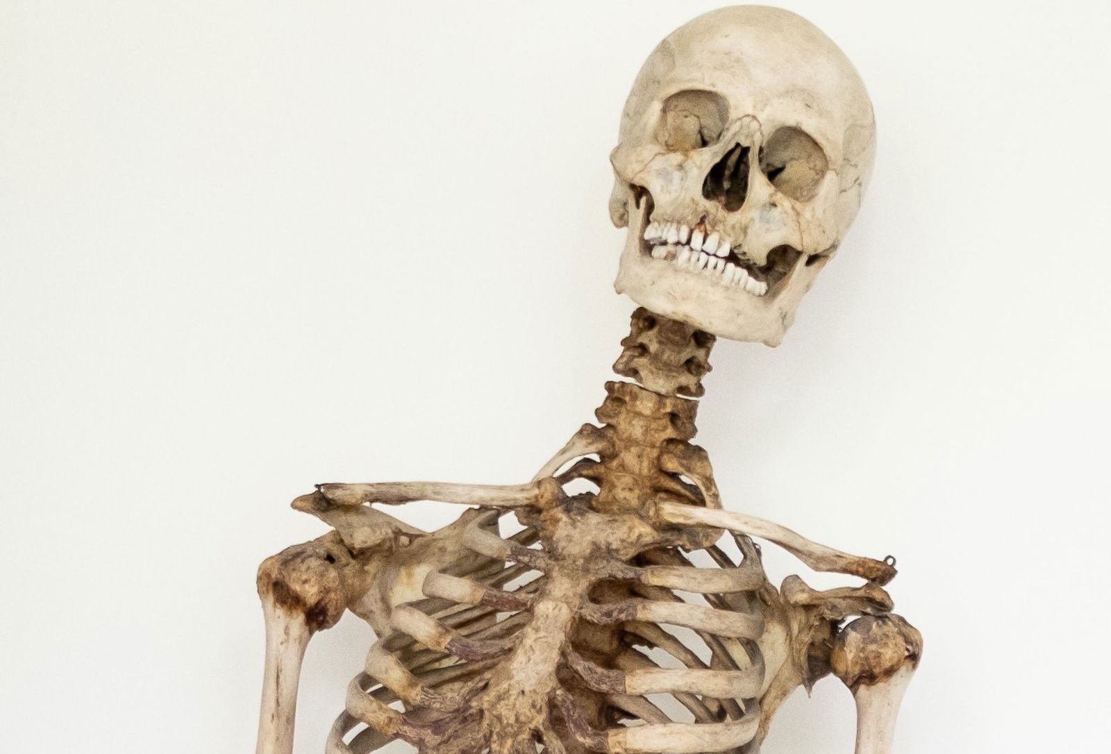 Dank wissenschaftlicher Analysen und eines Verwandten weiß man nun, dass dieses Skelett die sterblichen Überreste des Räubers Schinderhannes sind.