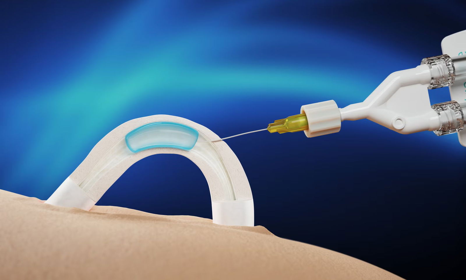 ADAM - Die Hyrdrogel-Spritze als Verhütung für den Mann