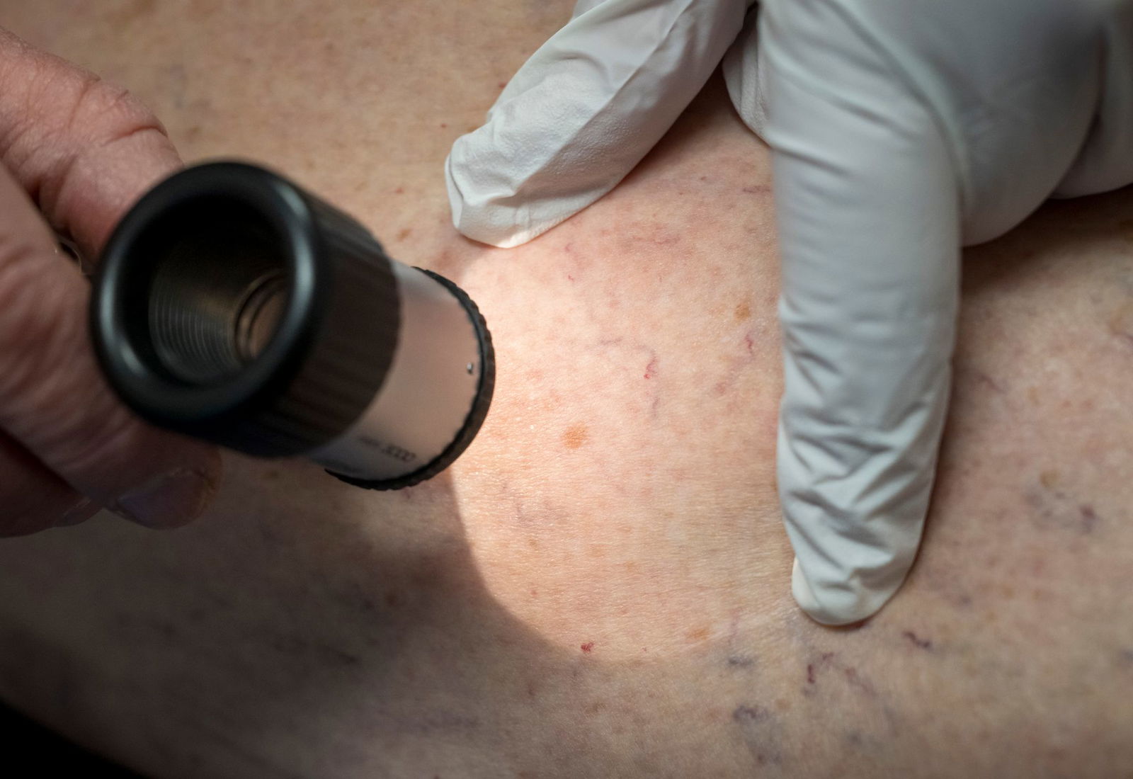 Eine neue Datenauswertung in Rheinland-Pfalz zeigt: Männer in dem Bundesland sterben häufiger an Hautkrebs als Frauen. (Symbolbild)