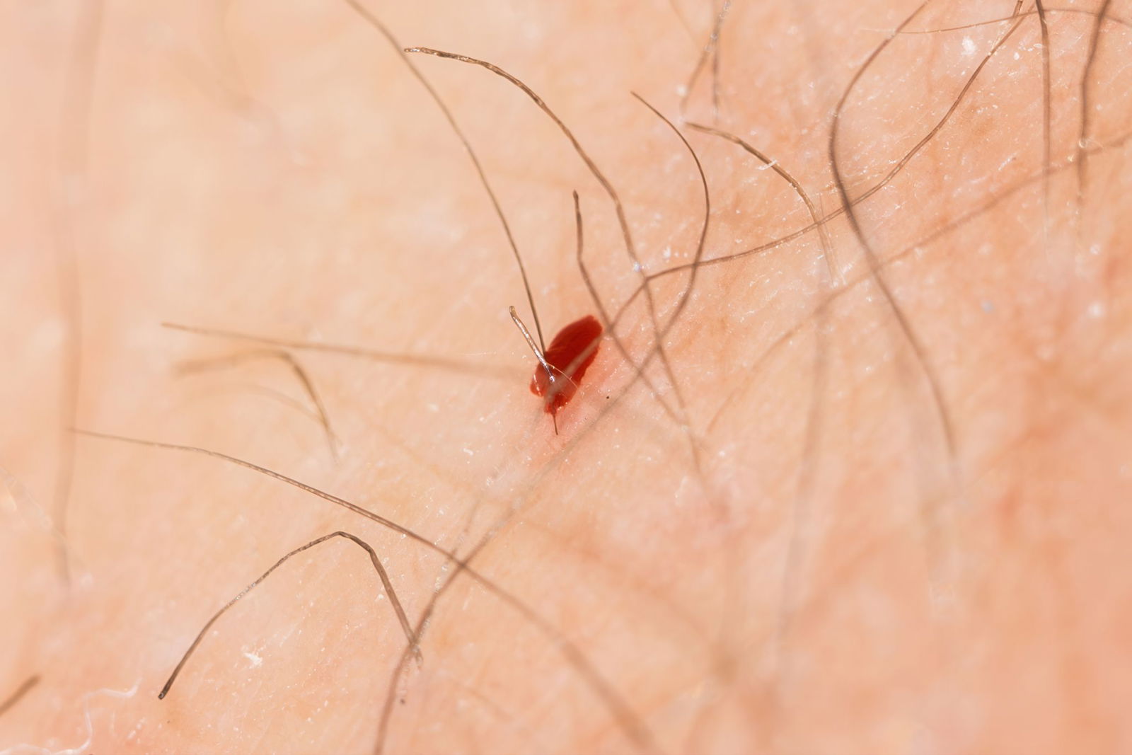 Der Biss einer Bremse ist oft blutig - und durchaus auch schmerzhaft.