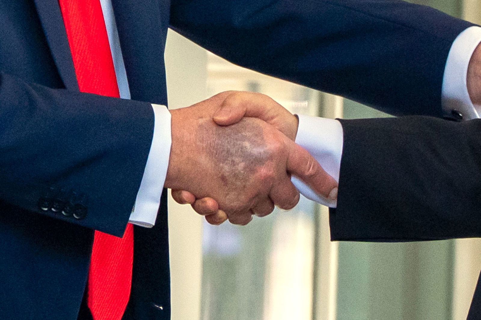 Zu sehen beim Händedruck mit dem südkoreanischen Präsidenten Lee: ein Bluterguss auf Trumps rechter Hand. 