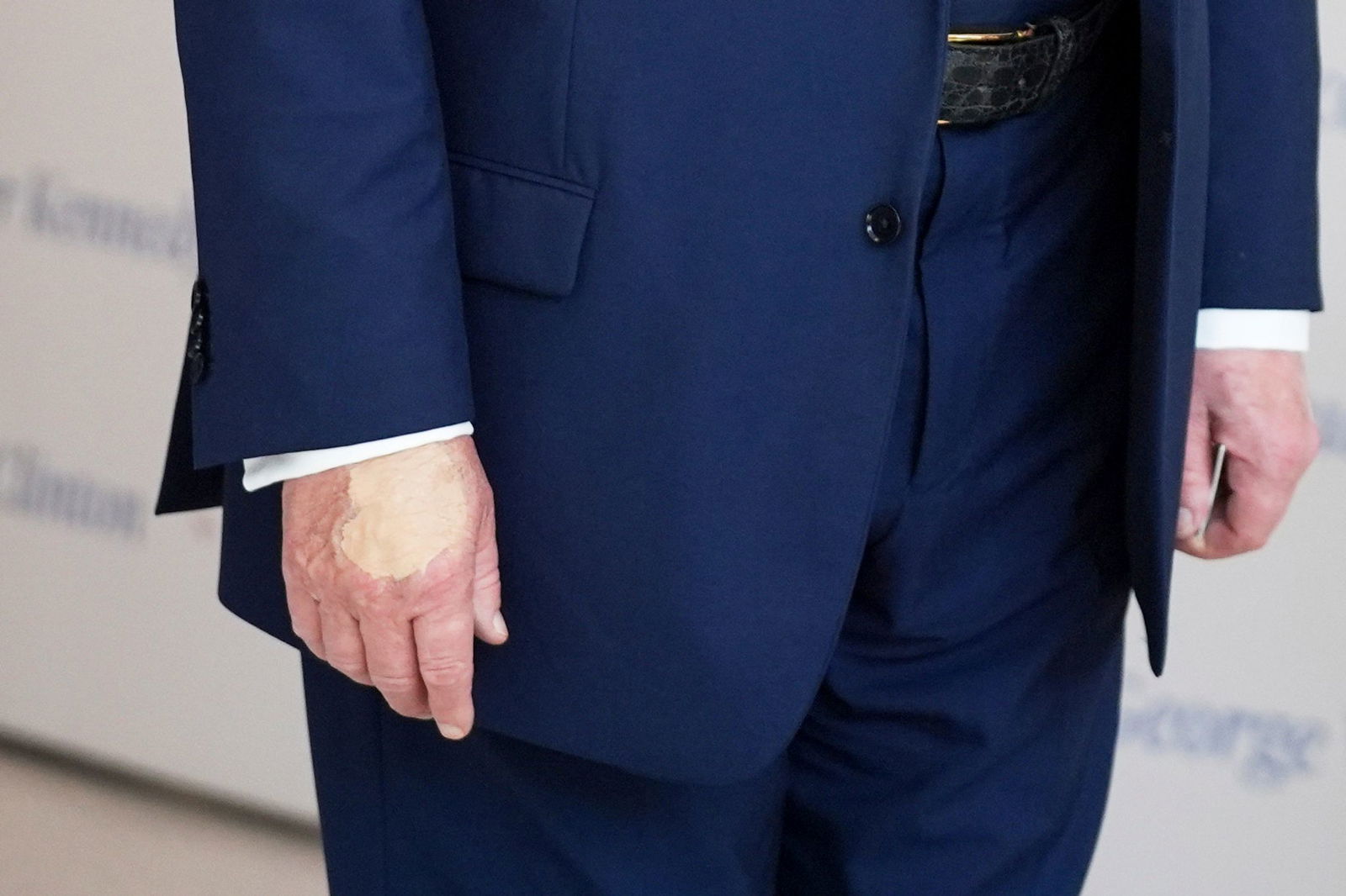 Für Trump ein unliebsames Thema: die überschminkte Hand (Archivbild).