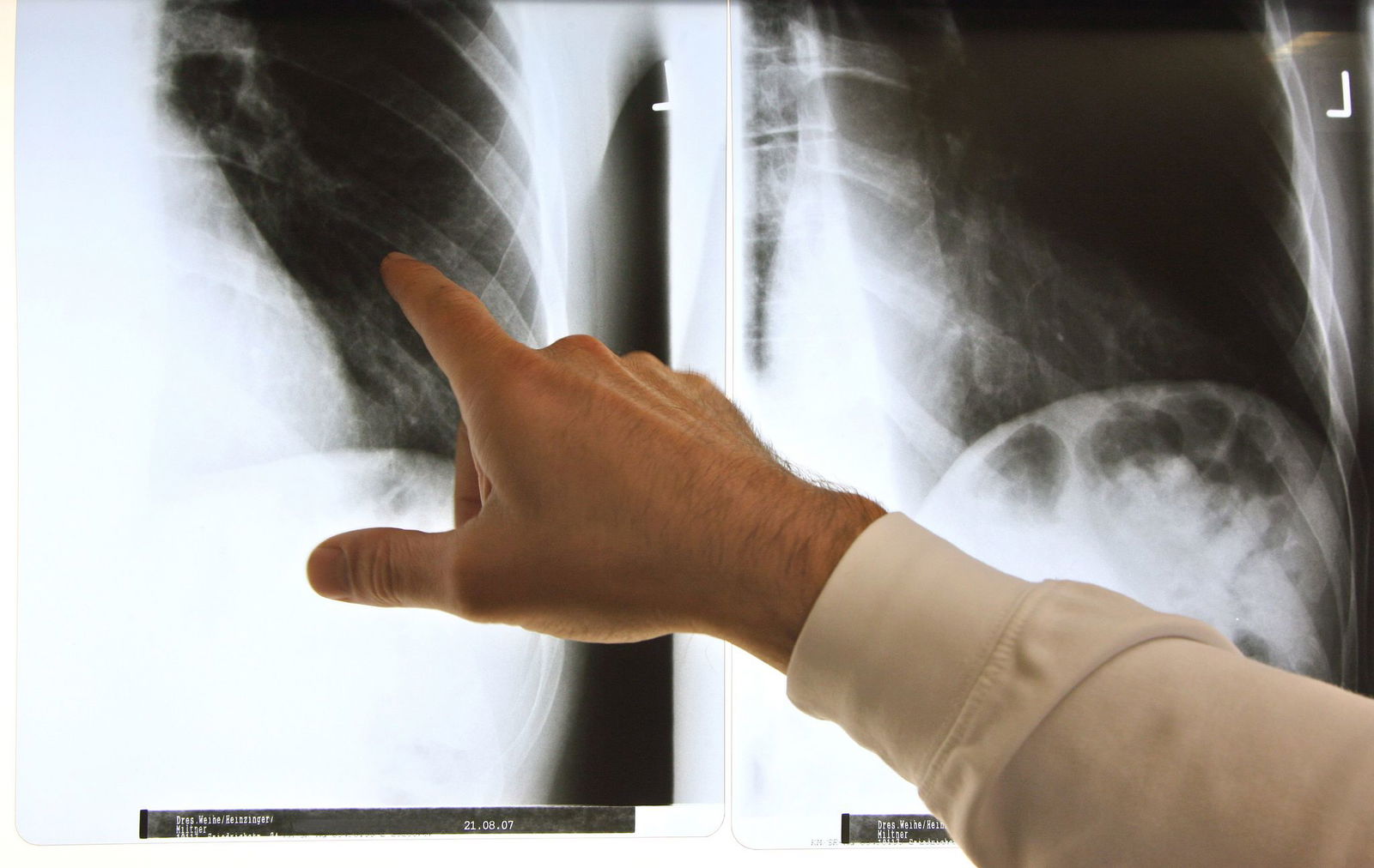 Wie kann ich Rheuma vorbeugen und wie kann die Behandlung von Betroffenen verbessert werden? Solche Fragen soll der Aktionsplan des Landes Rheinland-Pfalz zu dem Thema beantworten. (Symbolbild)