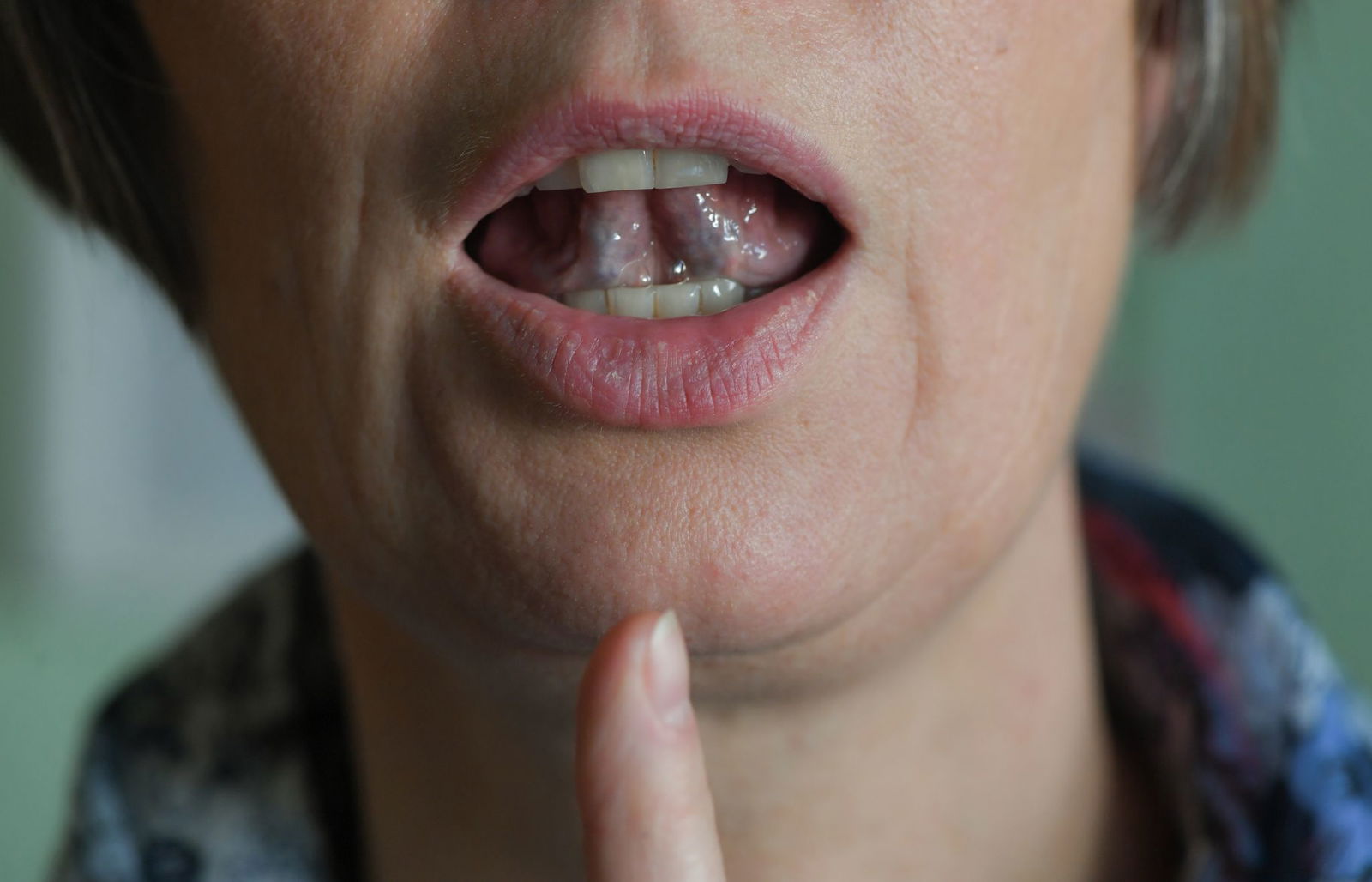 Bundesweit gelten rund ein Prozent der Bevölkerung als betroffen vom Stottern – in Rheinland-Pfalz entspricht das etwa 41.000 Menschen, im Saarland rund 9.900. (Symbolbild)