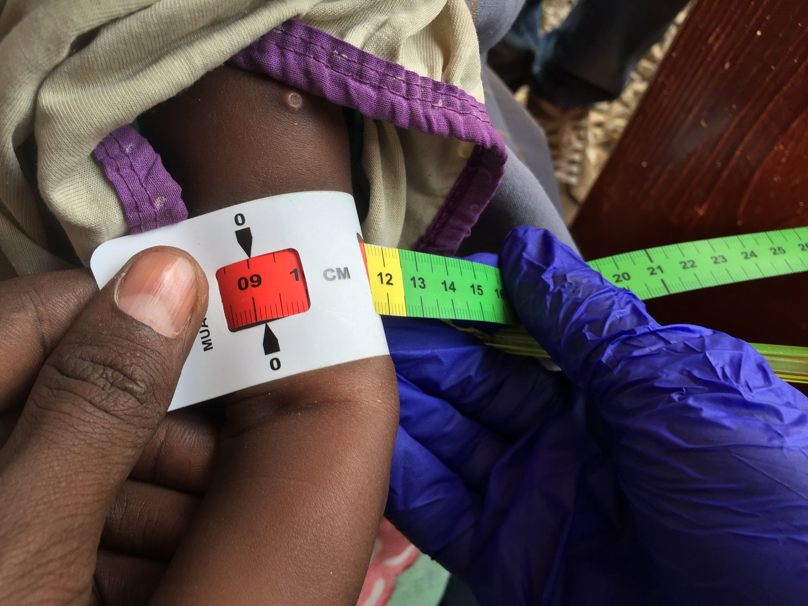 Schon jetzt gelten fast zwei Millionen Kinder in Somalia akut unterernährt. (Archivbild)