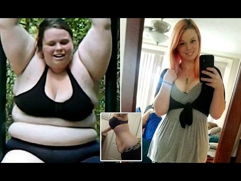 Woman dropped 193lbs reveals the downside   including stretch marks and loose skin   to weight loss