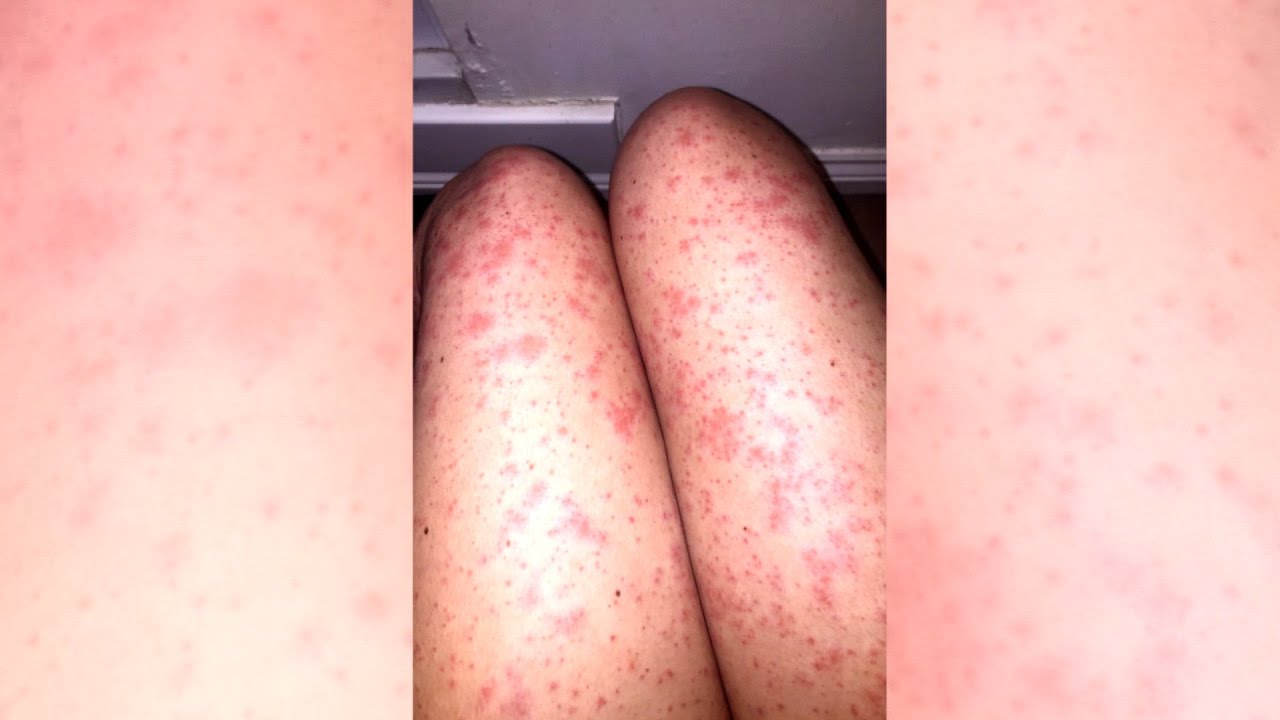 21-Year-Old Woman Is Shocked To Learn Her 'Razor Burn' Is Actually Cancer