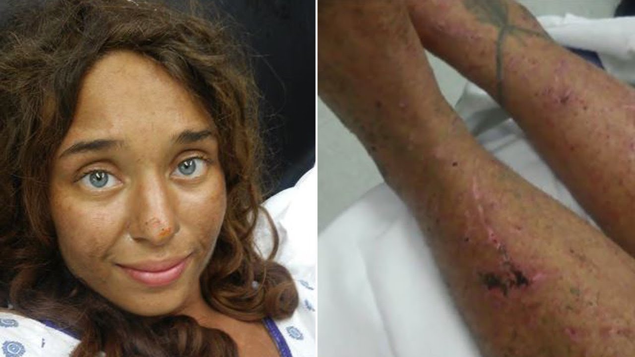 Woman Missing for Weeks Found Alive in Woods, Survived on Muddy Water: Cops