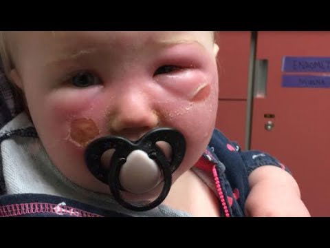 Sunscreen complaints: Dermatologist on what you need to know