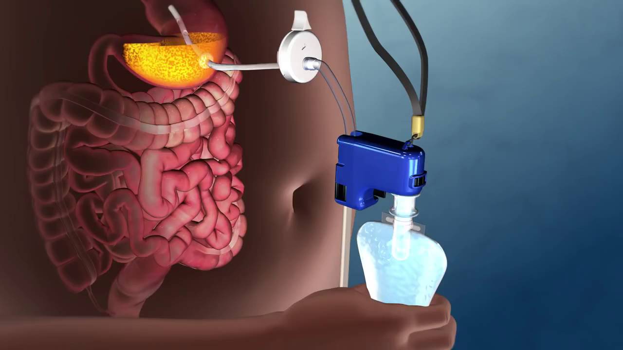 The FDA approved a weight-loss device that sucks food out of your stomach