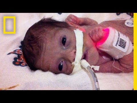 Born 4 Months Early, This Tiny Survivor Beats the Odds