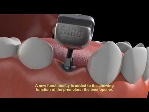 Flaschenöffner als Zahnersatz