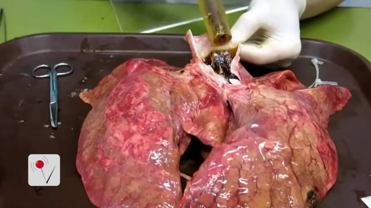This is What Your Lungs Look Like After 20 Cigarettes