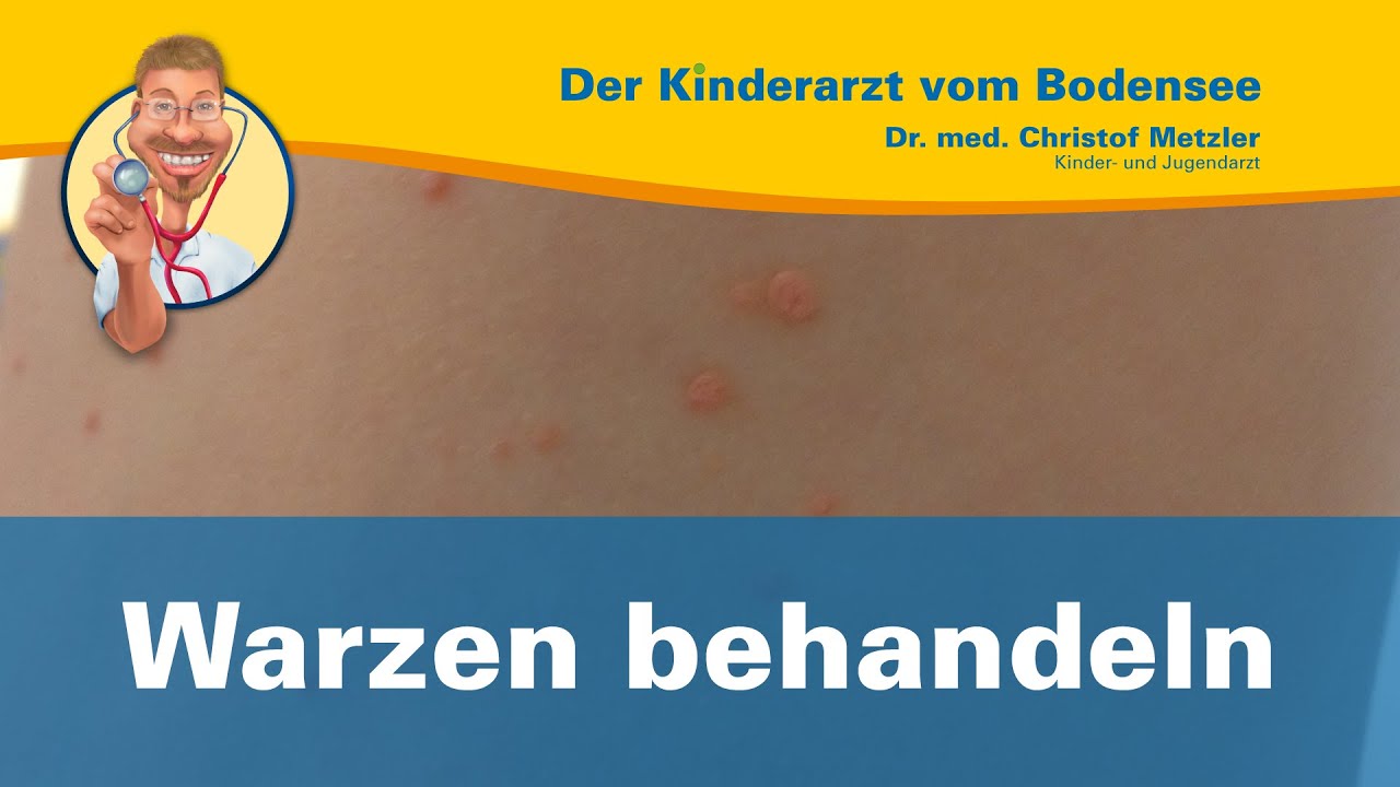 Warzen behandeln - Der Kinderarzt vom Bodensee [Warzen 2/2]