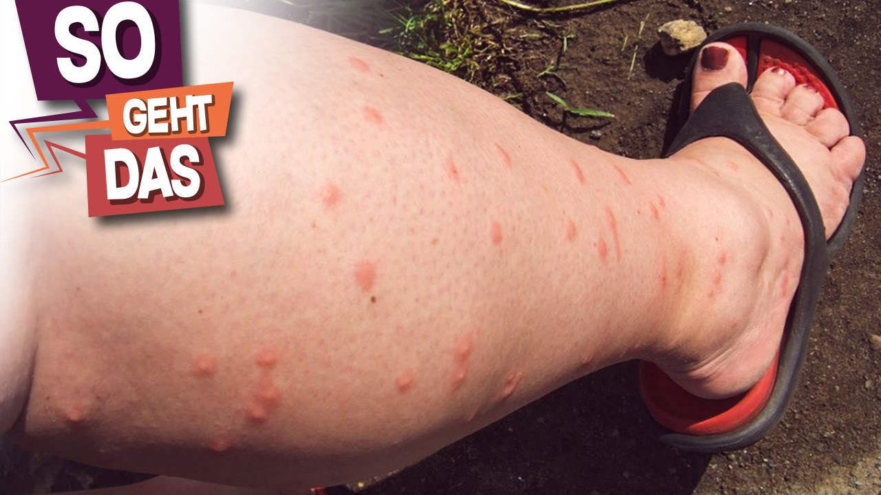 Was gegen Mückenstiche WIRKLICH hilft