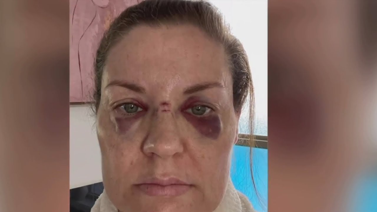 Guns N’ Roses fan hit in nose by flying microphone