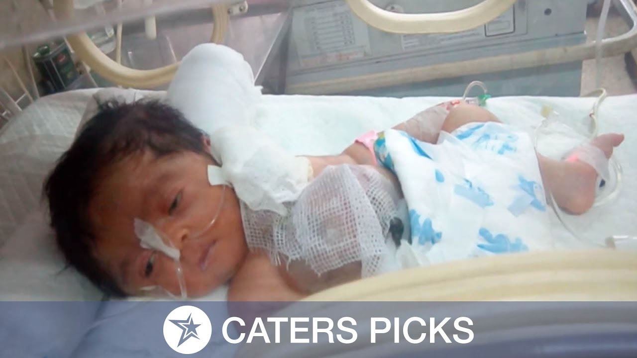 Pakistani Baby Born With Heart Outside Chest