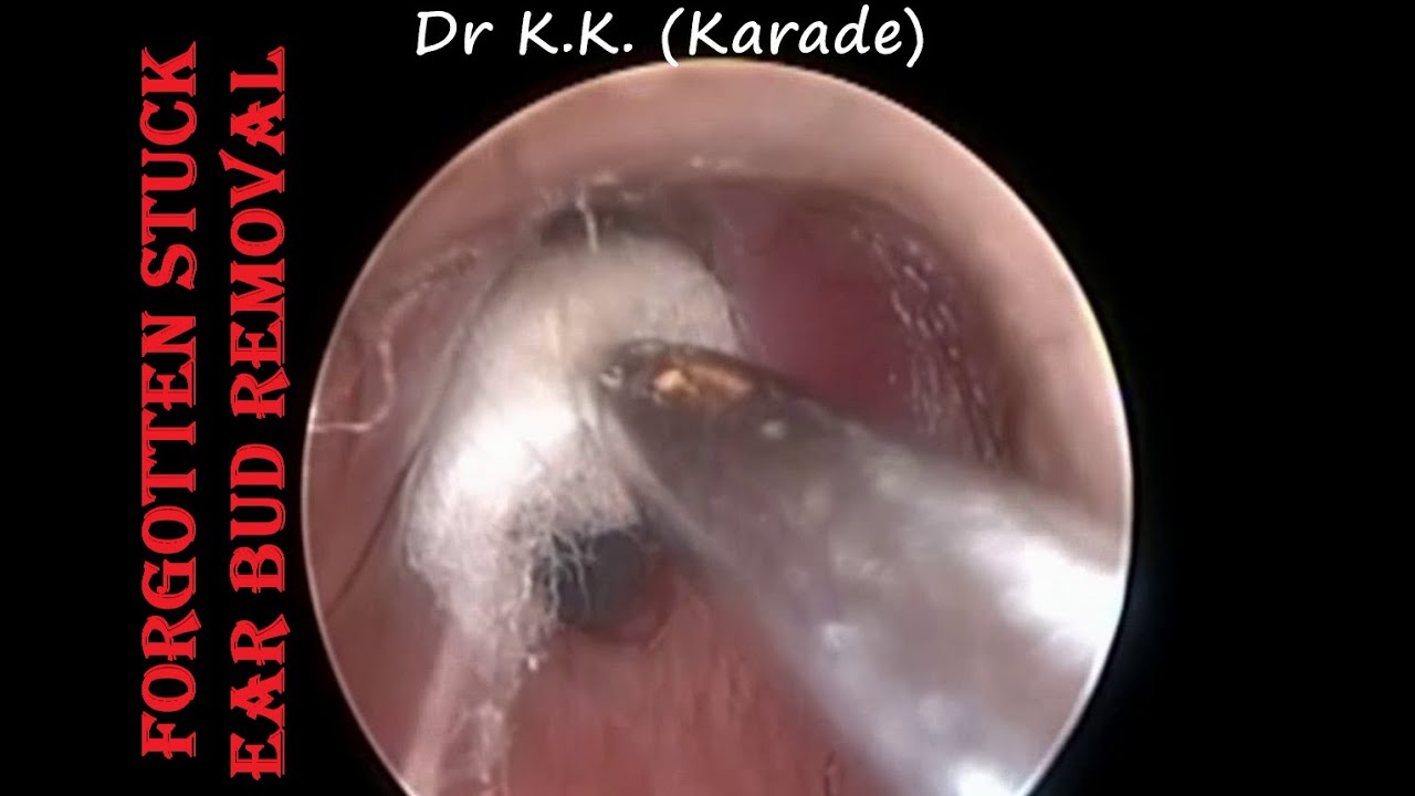 Oto-endoscopic Removal of Forgotten Stuck Ear bud from Ear Canal